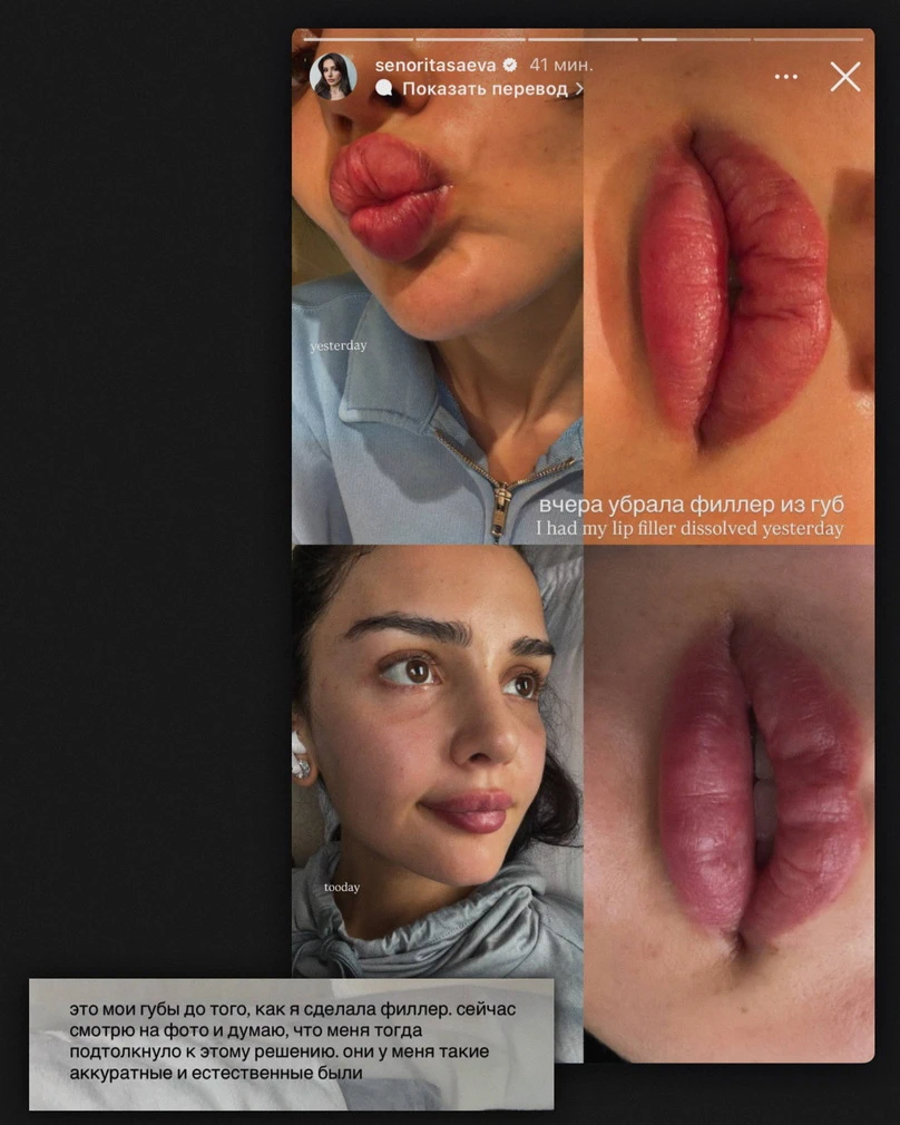 Дина Саева до и после изменений внешности